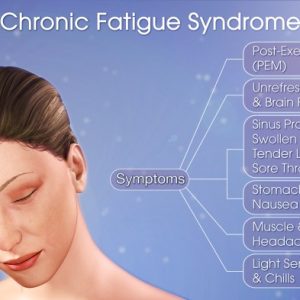 Symptoms of chronic fatigue syndrome